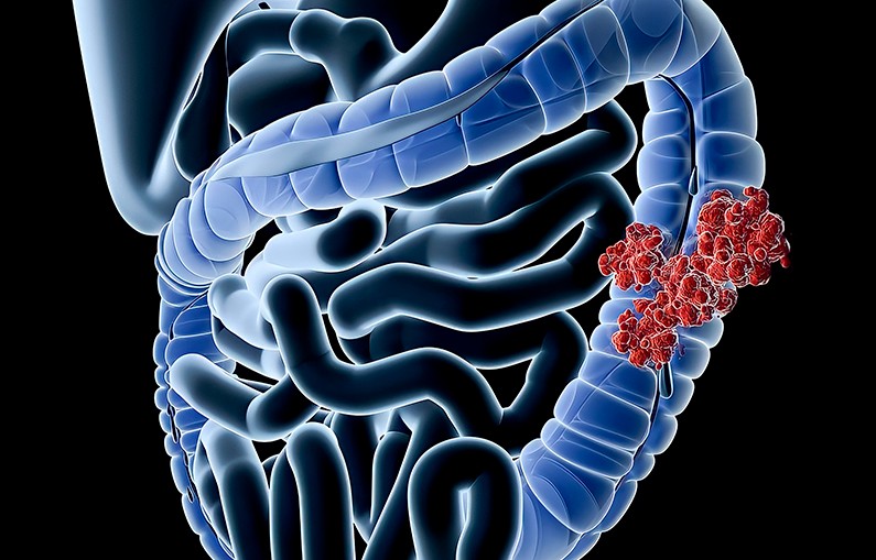 Precisamos falar sobre o Câncer Gastrointestinal.