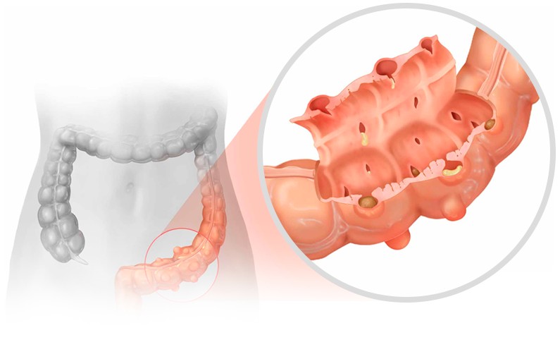 Diverticulite: conheça a moléstia diverticular do cólon!