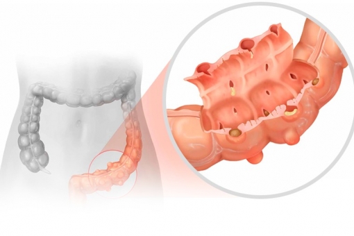 Diverticulite: conheça a moléstia diverticular do cólon!